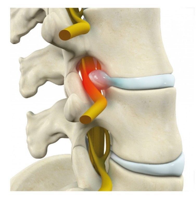 Hernias discales: una condición frecuente que exige comprensión y atención adecuada