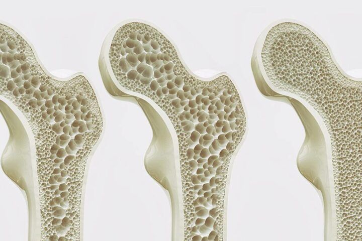 Osteoporosis: cómo detectarla, tratarla y regenerar la salud ósea